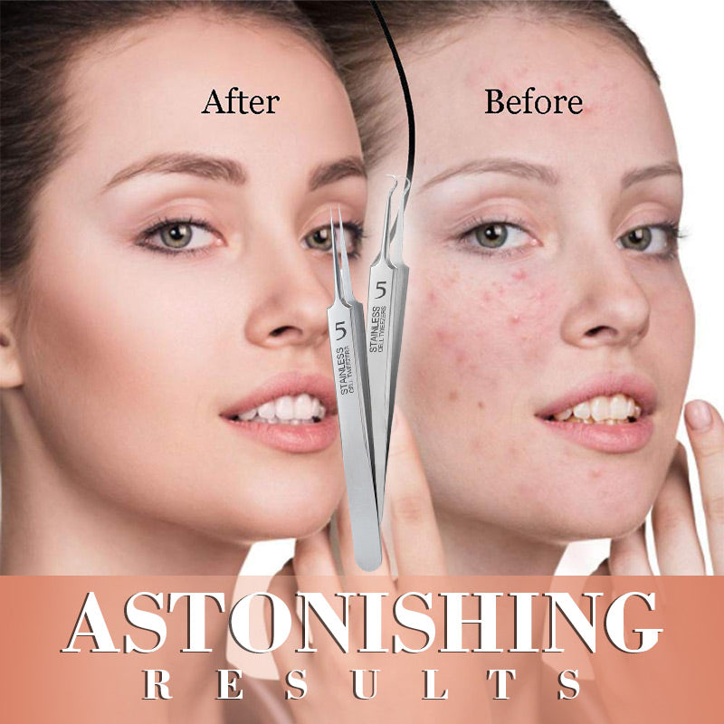 ClearSkin Pro – Sanfte Entfernung von Pickeln & Mitessern